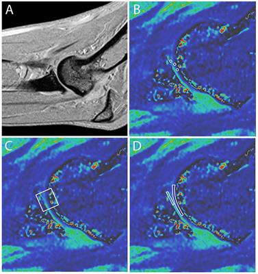 Utility of MRI for Characterizing Articular Cartilage Pathology in Dogs with Medial Coronoid Process Disease